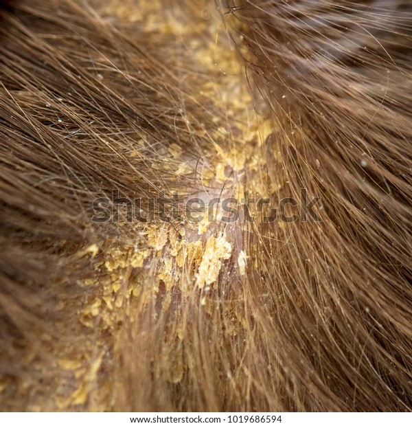 Dandruff in the hair. Flaky scalp. Seborrhea.\
Macro shot. Children\'s dandruff. Seborrheic dermatitis. Scales on\
the scalp and on the hair.\
