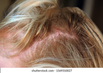 Dandruff in the hair and scalp.	 - Shutterstock ID 1569310027