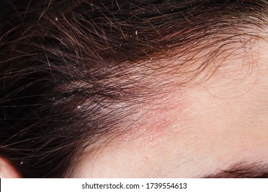 Dandruff in the hair and temples of a young woman. Dry scalp skin itches - Shutterstock ID 1739554613