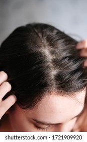 Dandruff On The Girls Head, Diseases Of The Scalp