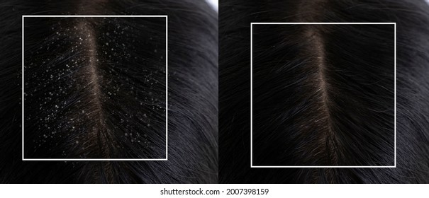 Dandruff On The Hair Before And After Treatment
