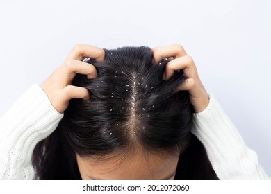 Dandruff problem. A girl with itchy head. Dandruff on the hair. Hair disease seborrhea. Fatty Dandruff.