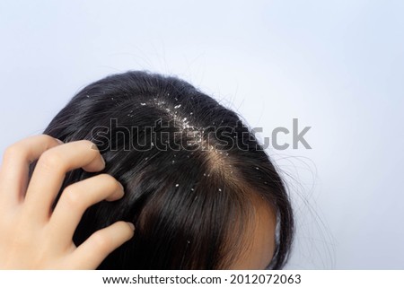 Dandruff problem. A girl with itchy head. Dandruff on the hair. Hair disease seborrhea. Fatty Dandruff. Foto stock © 