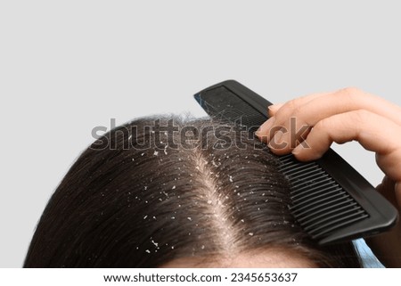 Dandruff problem. A girl with itchy head. Dandruff on the hair. Hair disease seborrhea. Fatty Dandruff. Foto stock © 