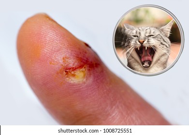 Dangerous Bite Of A Cat In The Finger, Infected Wound With Inflammation. Hig Risk Of Blood Poisoning