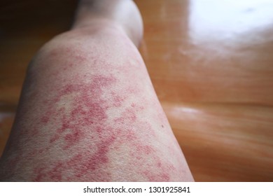 Dangerous Red Spicy Itchy Skin On Leg Of Sick Man.