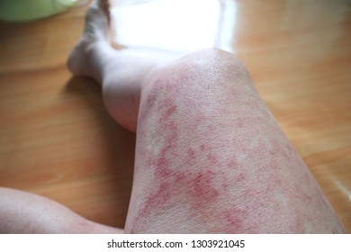 Dangerous Red Spicy Itchy Skin On Left Leg Of Sick Man.