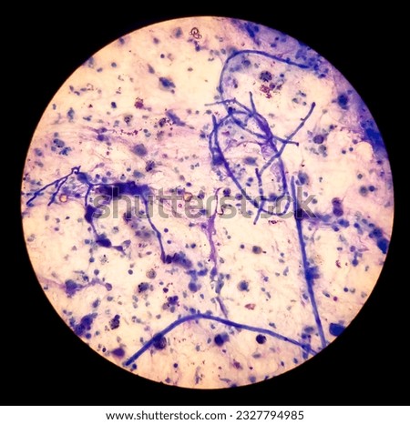 Dark blue hyphae and yeasts forms of Candida in cytopathology seen under a light microscope (Gram stain) 100x

