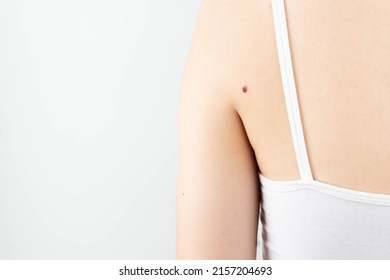 Dark Brown Moles On Woman Back Skin. Awareness Of Changes In Your Moles To Detecting Skin Cancer, Especially Malignant Melanoma. Skin Disease Concept.