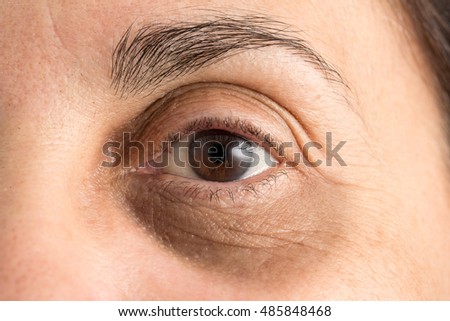 Dark circles