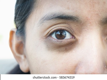 Dark Circles Around Eye.