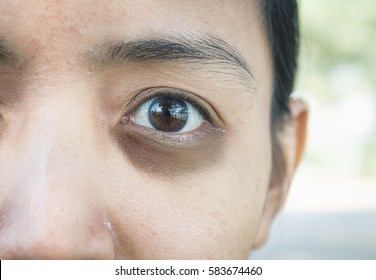 Dark Circles Around Eye.