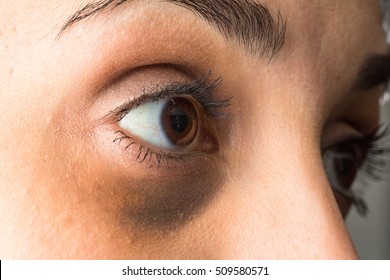 Dark Circles Eyes