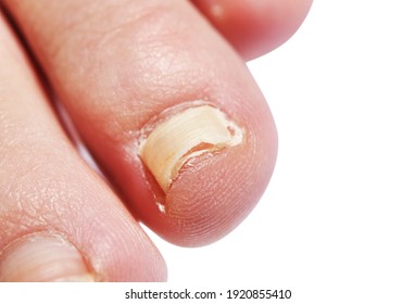 18 Toe Nail Coming Off Images, Stock Photos & Vectors | Shutterstock