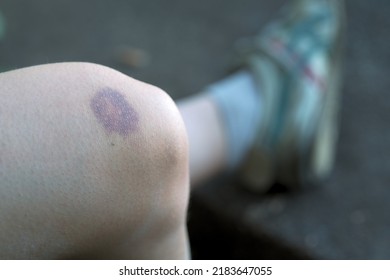 Dark Purple Bruise Of A Woman Leg On Her Knee