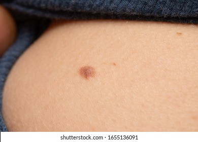 Dark And Raised Neo On Skin. Benign Formation. Skin Monitoring Concept For Melanoma Prevention