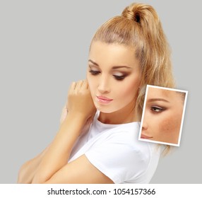 Dark spots, freckles,hyperpigmentation(melasma or chloasma)