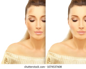 Dark spots, freckles,hyperpigmentation(melasma or chloasma)