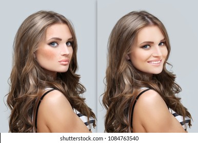 Dark spots, freckles,hyperpigmentation(melasma or chloasma)