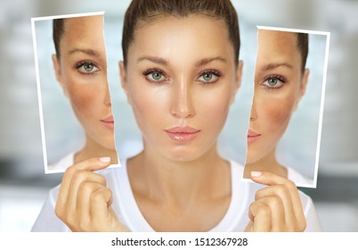 Dark spots, freckles,hyperpigmentation(melasma or chloasma) - Shutterstock ID 1512367928