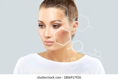 Dark spots, freckles,hyperpigmentation(melasma or chloasma) - Shutterstock ID 1806917926