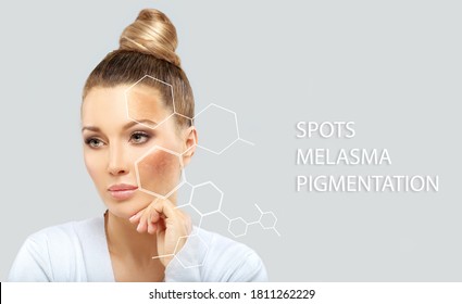 Dark spots, freckles,hyperpigmentation(melasma or chloasma)	