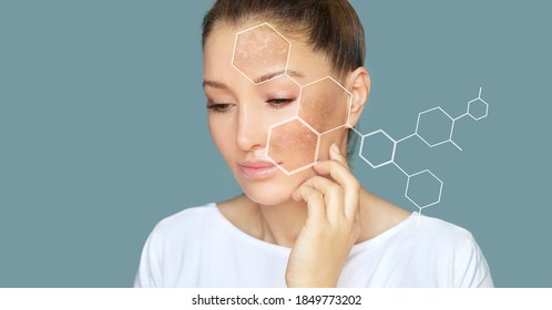 Dark spots, freckles,hyperpigmentation(melasma or chloasma)	 - Shutterstock ID 1849773202