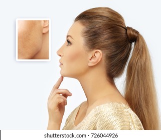 Dark spots, freckles,hyperpigmentation(melasma or chloasma)