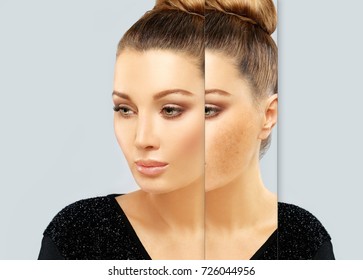 Dark spots, freckles,hyperpigmentation(melasma or chloasma)