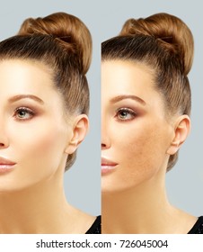 Dark spots, freckles,hyperpigmentation(melasma or chloasma)
