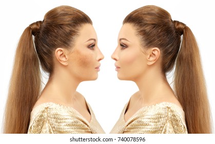 Dark spots, freckles,hyperpigmentation(melasma or chloasma)
