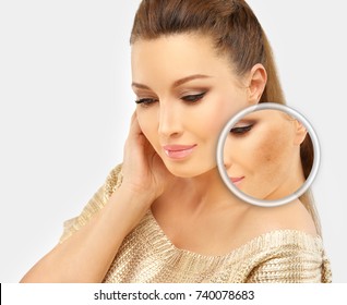 Dark spots, freckles,hyperpigmentation(melasma or chloasma)