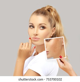 Dark spots, freckles,hyperpigmentation(melasma or chloasma)