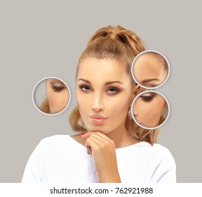 Dark spots, freckles,hyperpigmentation(melasma or chloasma)