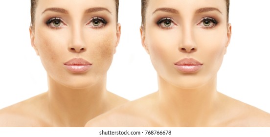 Dark spots, freckles,hyperpigmentation(melasma or chloasma)