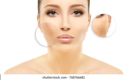 Dark spots, freckles,hyperpigmentation(melasma or chloasma)