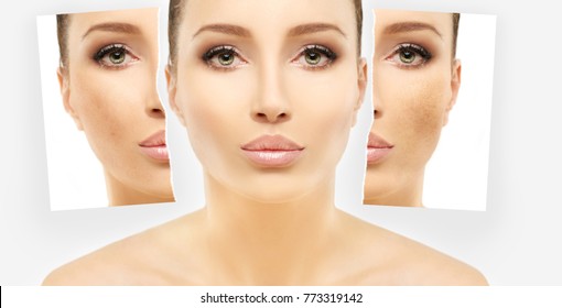 Dark spots, freckles,hyperpigmentation(melasma or chloasma)