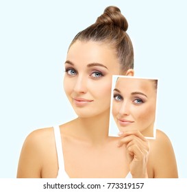 Dark spots, freckles,hyperpigmentation(melasma or chloasma)