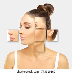 Dark spots, freckles,hyperpigmentation(melasma or chloasma)