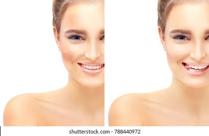 Dark spots, freckles,hyperpigmentation(melasma or chloasma)