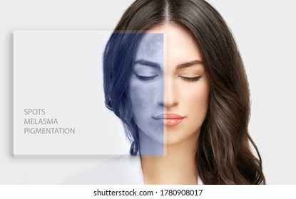 Dark spots, freckles,hyperpigmentation(melasma or chloasma),concept- skin lightening, skin whitening, Skin Brightening - Shutterstock ID 1780908017