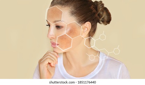 Dark spots, freckles,hyperpigmentation(melasma or chloasma),concept- skin lightening, skin whitening, Skin Brightening	 - Shutterstock ID 1851176440