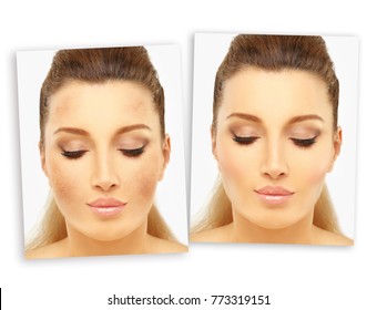 Dark spots, freckles,hyperpigmentation(melasma or chloasma).Showing photos before and after
