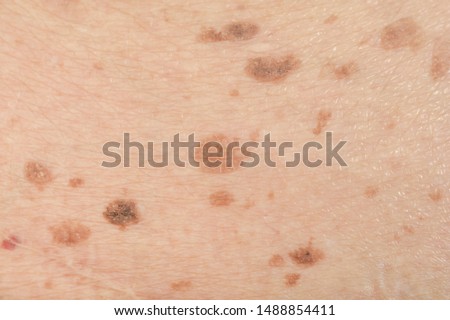 Dark spots and skin problems and itching Skin disease  freckles on the skin
