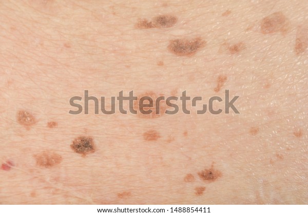 Dark spots and skin problems and itching Skin\
disease  freckles on the\
skin