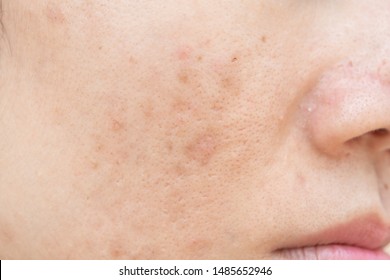  Dark spots. Wrinkles and skin problems Acne scars on face.