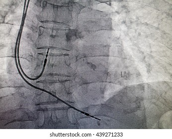 DDDR Pacemaker Cable In X-ray Image In Cardiac Catheterization Laboratory