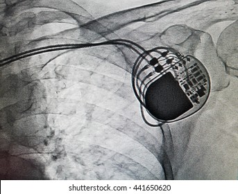 DDDR Pacemaker In X-ray Image In Cardiac Catheterization Laboratory