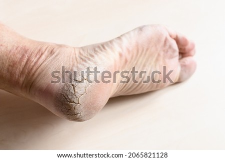 dead dry cracked skin on heel of male foot close up