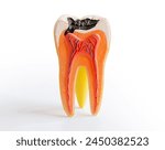 Decay tooth replace with dental implant root canal teeth model for education isolated on white background with clipping path.